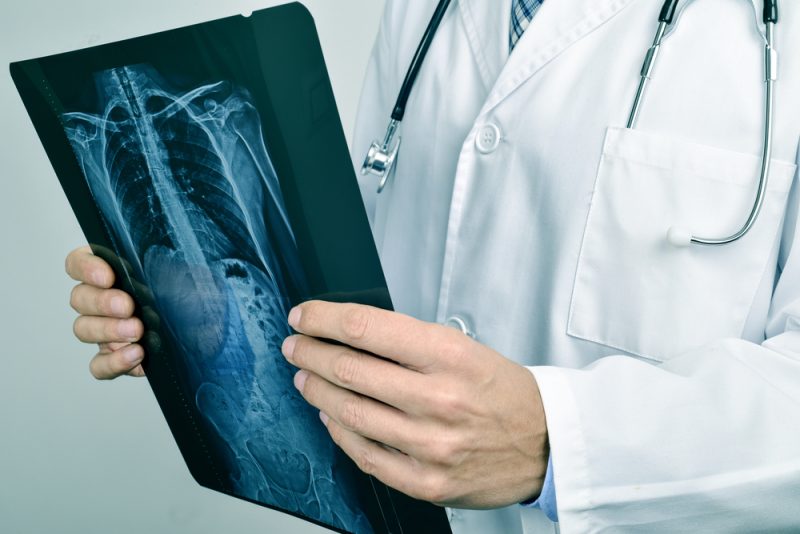 Calcaneus Fracture Workers' Compensation Pasadena thumbnail